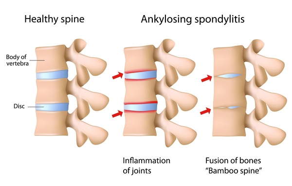 back pain and ankylosing spondylitis